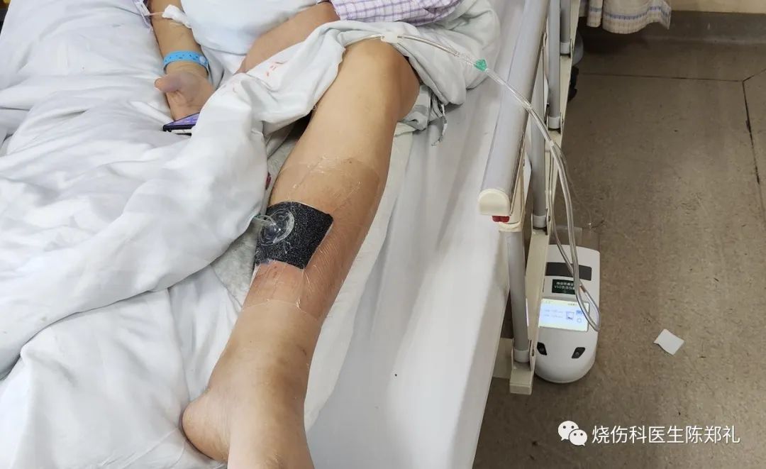 慢性创面患者的敷料运用及选择,创面换药敷料的选择