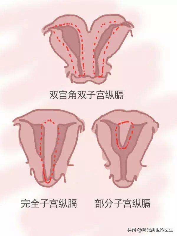 幼稚子宫能怀孕吗,始基子宫和幼稚子宫