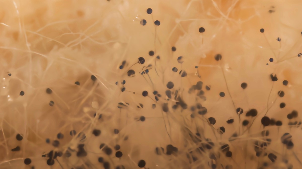 女子腹部痒，医生用镊子夹出16只阴虱！原来阴虱有4个传播途径