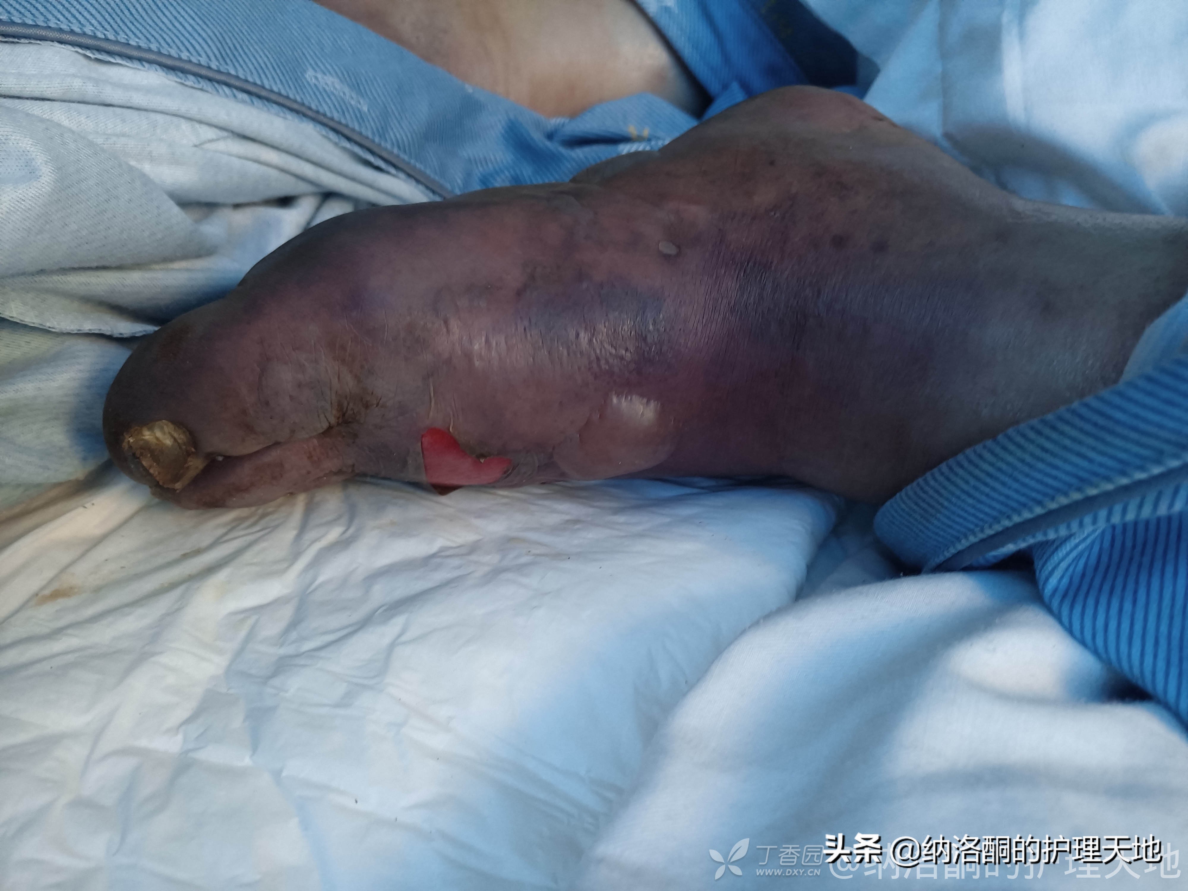 怎么治大水泡,大水泡怎么回事