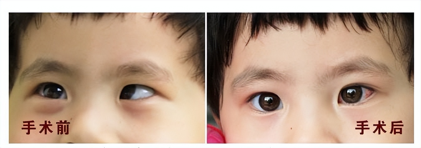 斜视的穴位治疗方法,斜视的最佳治疗方法是什么