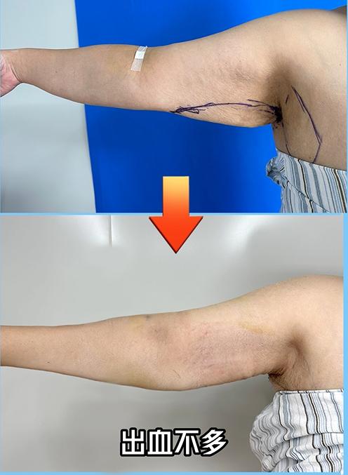 瘦手臂最快的方法吸脂,吸脂瘦手臂前后对比图