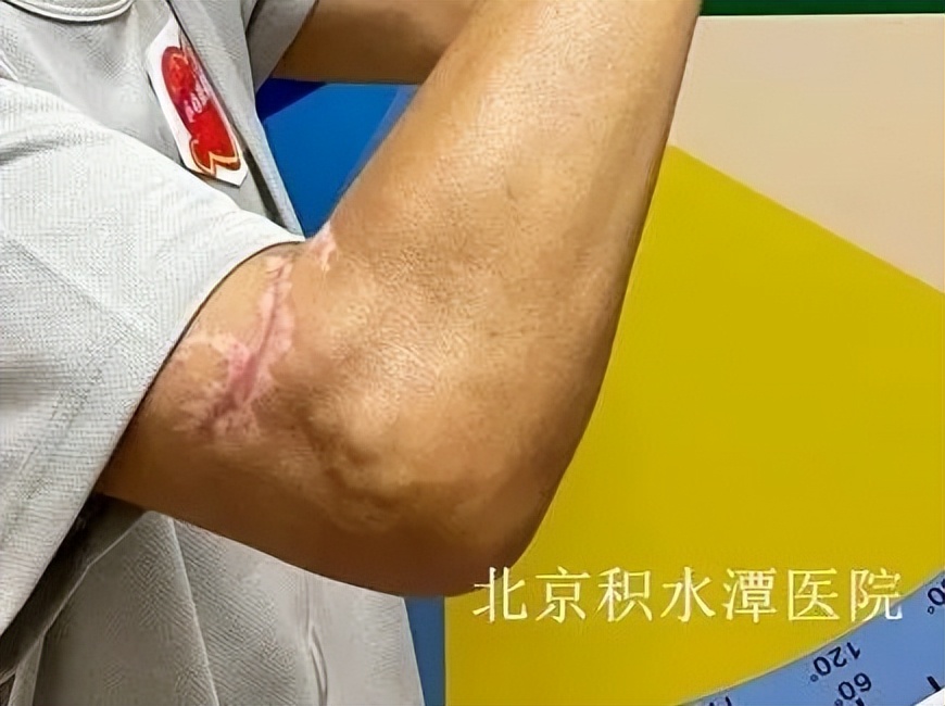 患者是我们最好的老师，也是我们创新的动力——北京积水潭医院蒋协远教授团队完成第二例肘关节表面置换手术