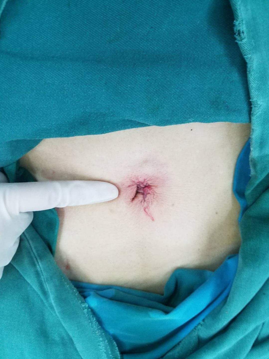 腹腔镜肾切除示意图,腹腔镜肾脏部分切除术