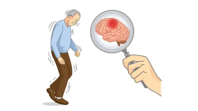 帕金森病人手抖,帕金森手抖调理好方法