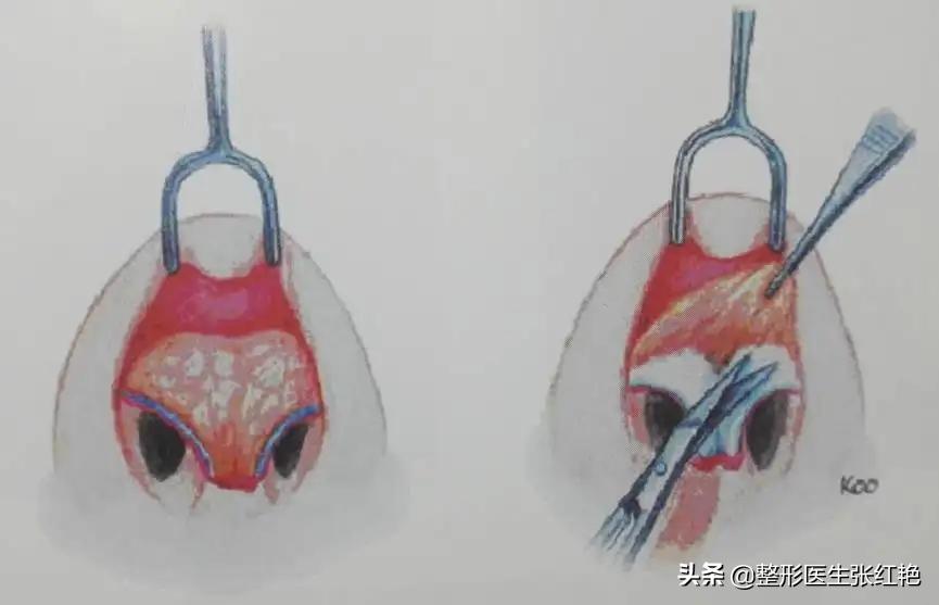 鼻部皮肤厚怎么办,鼻头软组织肥厚应该用什么材料