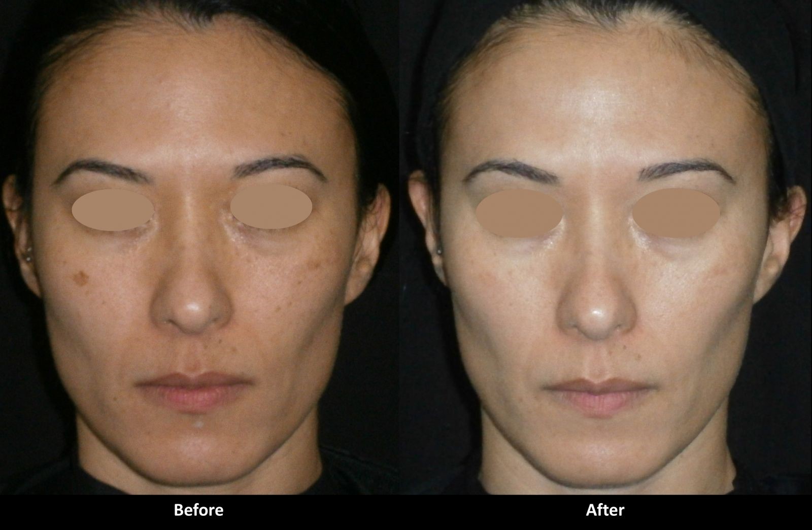 黑金光子嫩肤的功效与副作用图片,光子嫩肤能维持多久有副作用吗