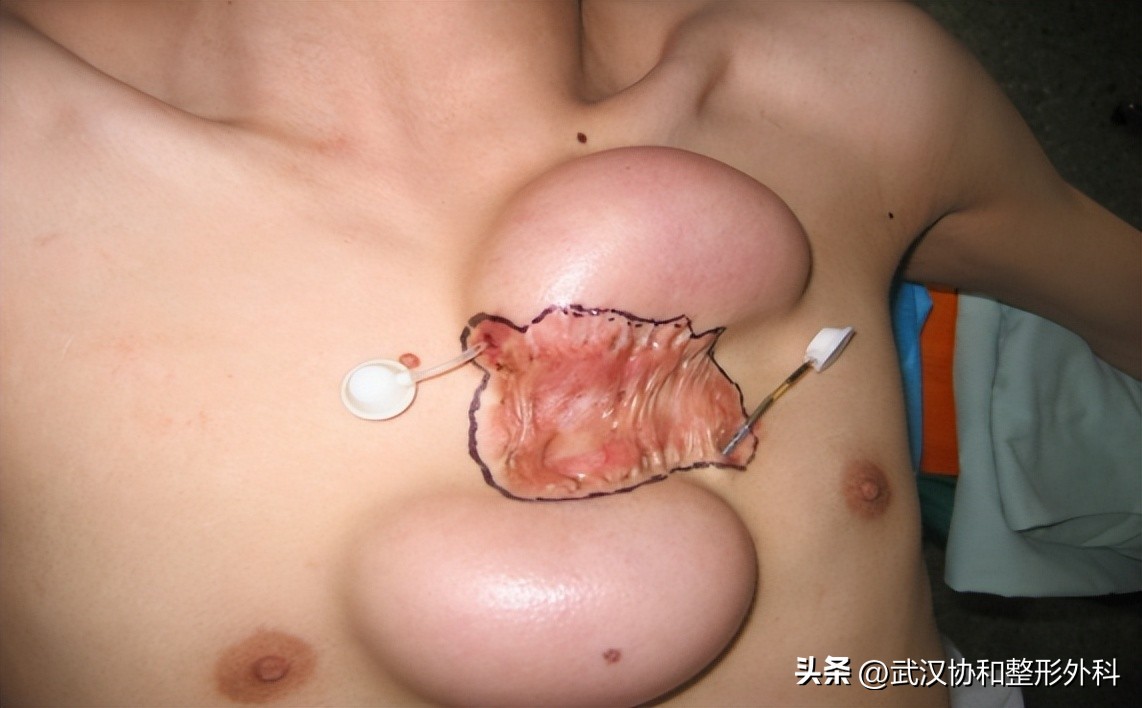 扩张器到底是什么？了解一下