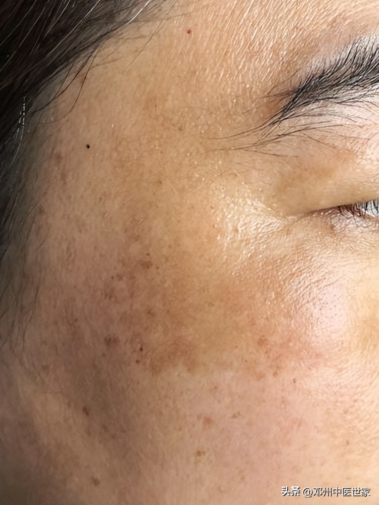 脸上长雀斑和晒斑要怎么内调,脸上长雀斑怎么内调