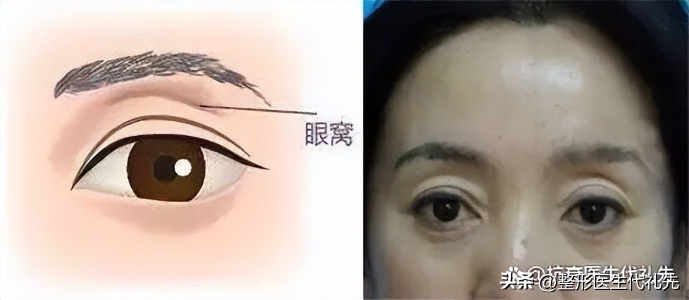 眼窝和法令纹凹陷很深怎么办,二十岁苹果肌饱满法令纹严重