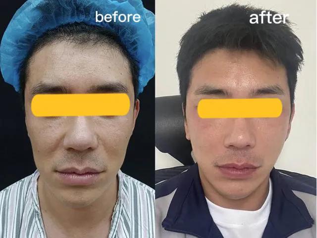 面部支架提升的操作过程,男性做支架后会有什么影响