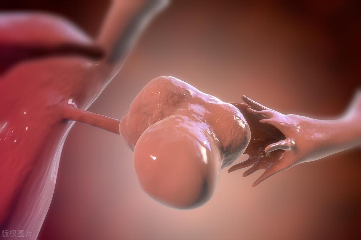 女人胸部长毛是不是雄性激素过高,女性体毛多属于多囊卵巢综合征吗