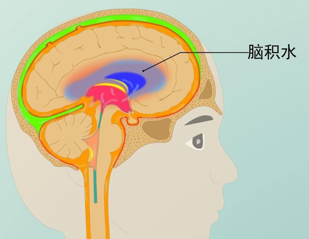 脑积水常见问题,脑积水不动手术能治好吗