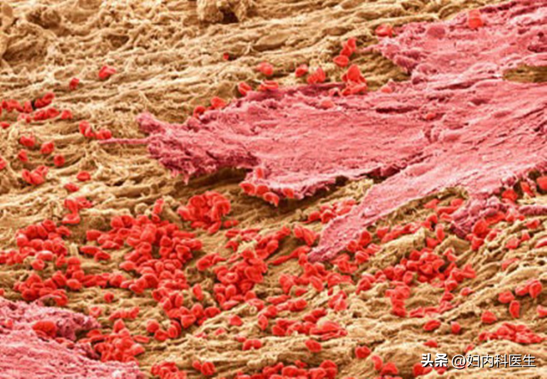 子宫长息肉是癌症的前兆吗,子宫颈长息肉是什么原因引起的