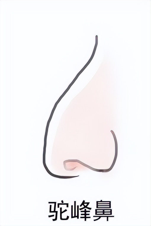 有驼峰的鼻子一定得磨吗,有驼峰的鼻子