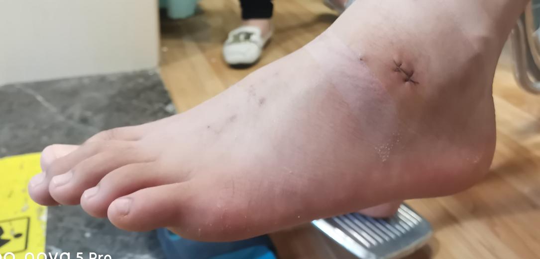 距下关节制动术成人效果如何,距下关节制动器作用