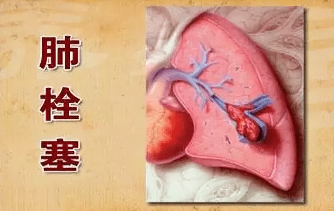 新冠引起肺静脉栓塞怎么办,新冠肺炎和肺动脉血栓怎么处理