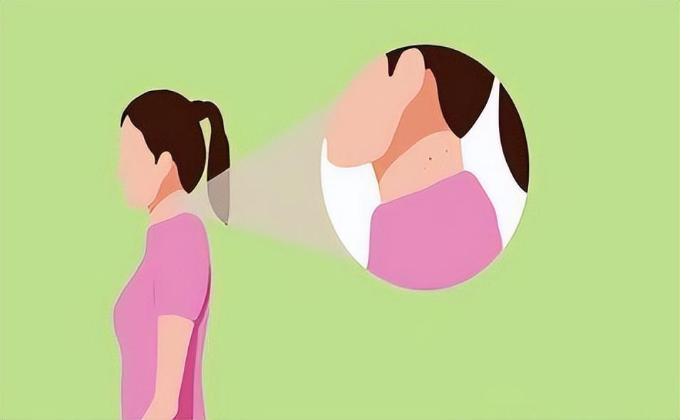 脖子上的小肉粒揪掉后会怎样,脖子上透明小肉粒可以揪下来