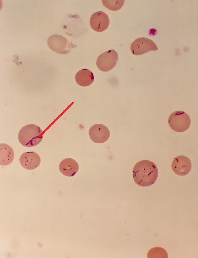 艾滋病腋下肿块,女子洗澡发现腋窝肿块