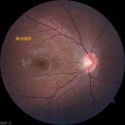 千万别和激光笔“对视”！13岁女孩只因看了一眼，眼底被灼伤