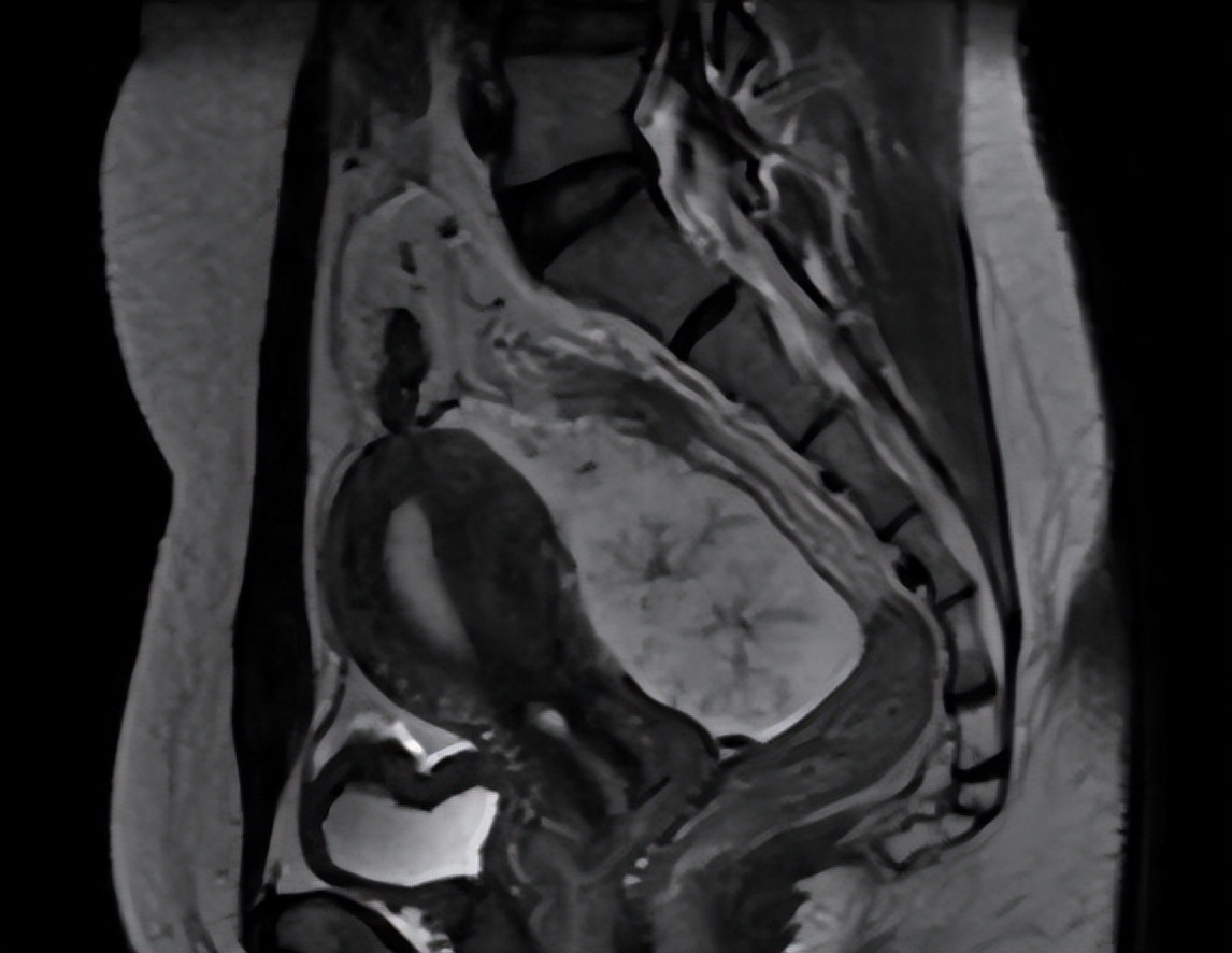 卵巢肿瘤引起肚子很大,肚子大检查发现是卵巢癌早期