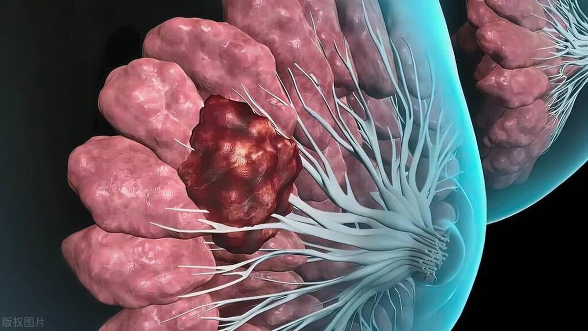 老婆出差回来，急着与她度过良宵，摸到她胸上有个硬块，是癌吗？