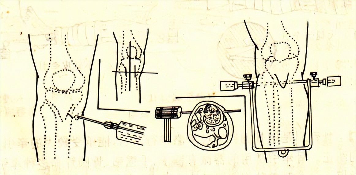 骨折后的并发症有哪些,骨折手术后需要注意哪些问题