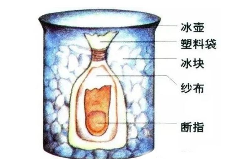 手指不小心切断了怎么办,手指不小心被切断了能接回来吗