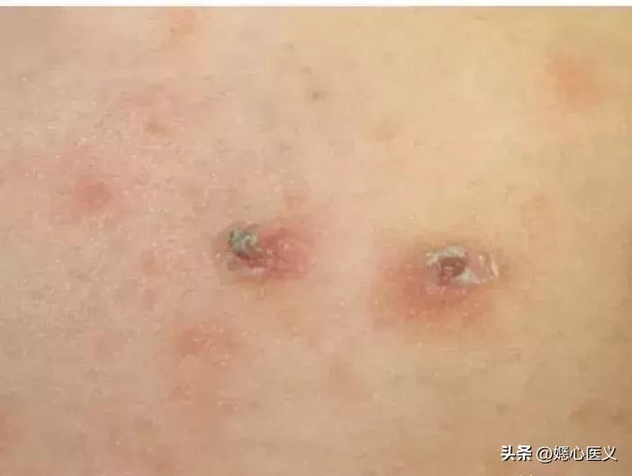 疥疮是什么病的症状啊,疥疮被传染的最初症状