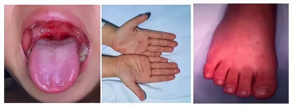 身上出现小红点，是血癌？医生：宝宝皮肤出现这3种异常，要当心