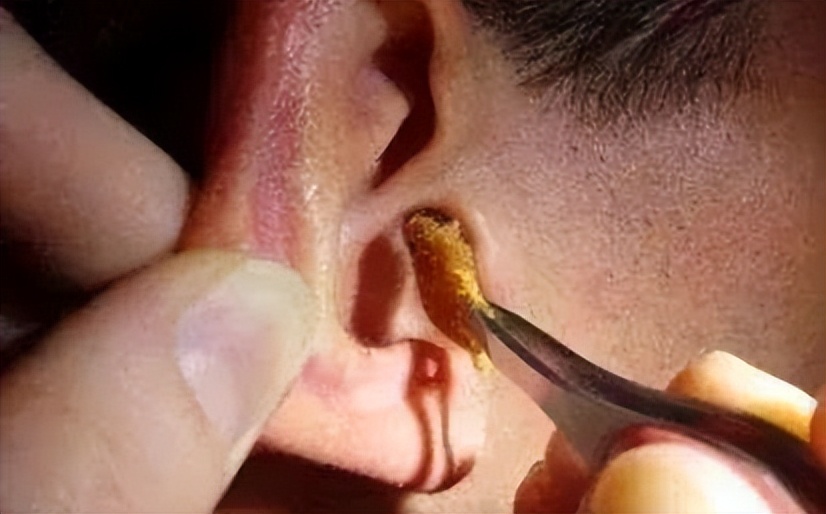 为什么有的人是油耳,糠耳与油耳的区别