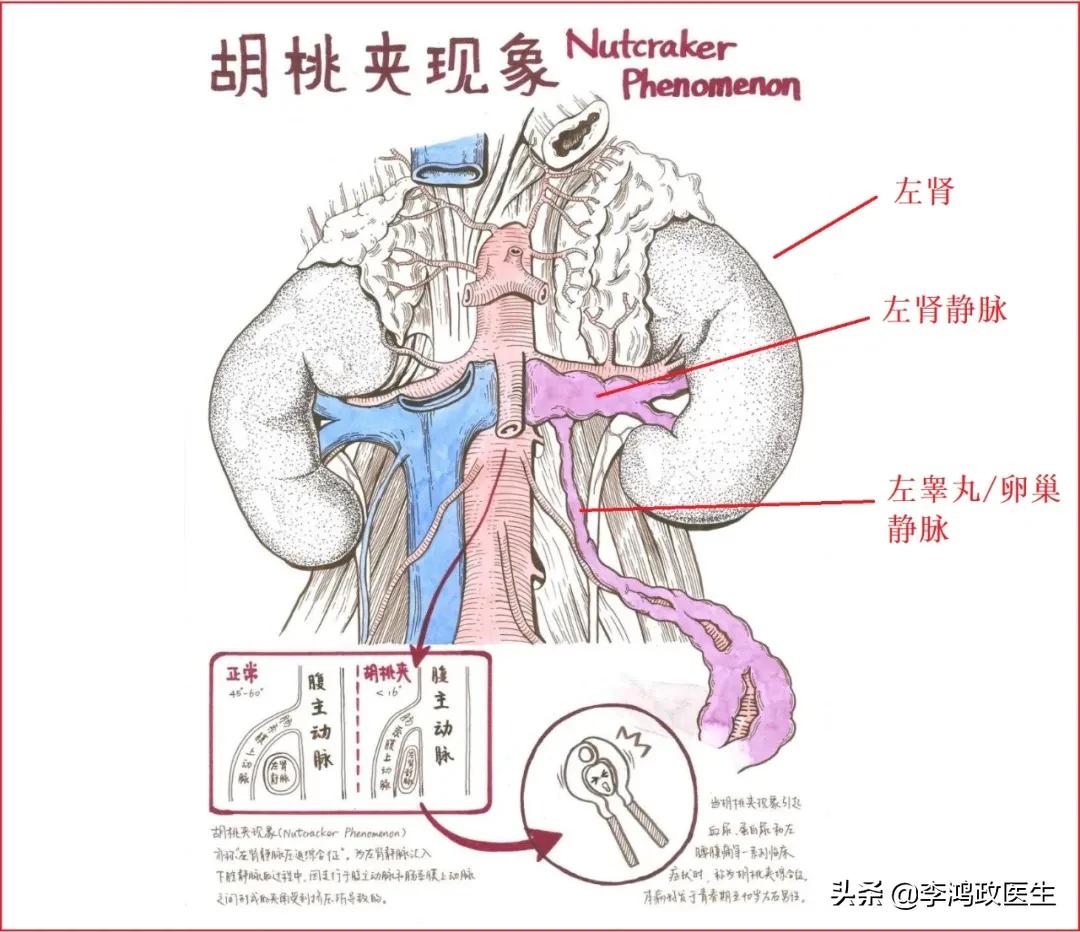 女子腰椎突出腰痛,女子腰椎间盘突出