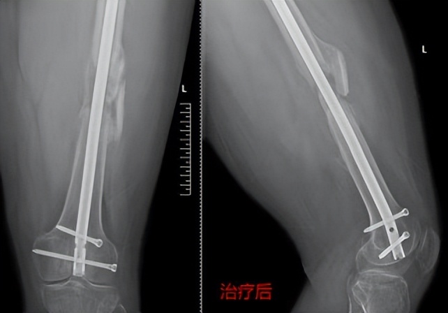 骨冲击波治疗仪,治骨疼痛最特效药方