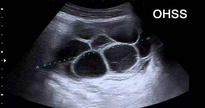 试管婴儿降调时有啥副作用,试管婴儿促排卵针有什么副作用