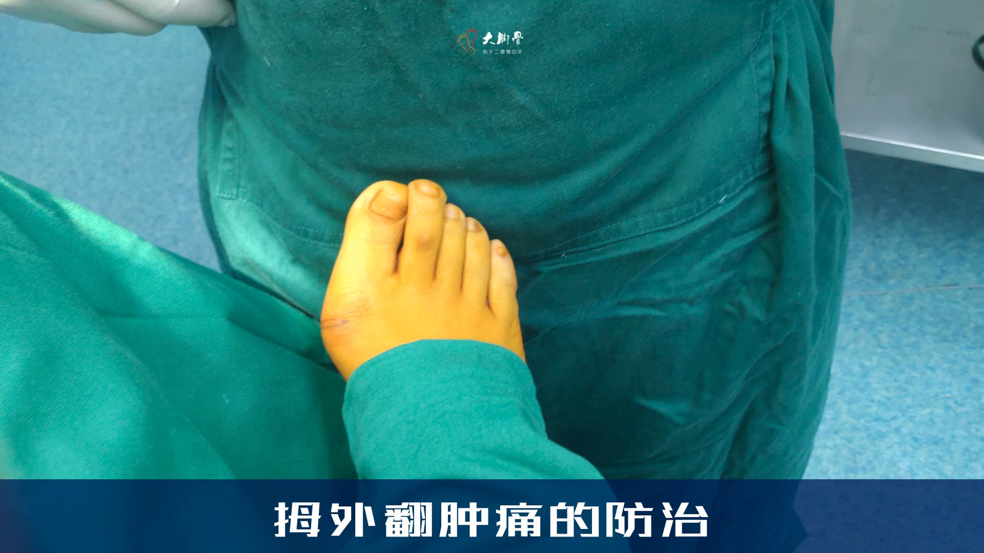 拇外翻疼痛怎么办,拇外翻疼痛的治疗方法药物