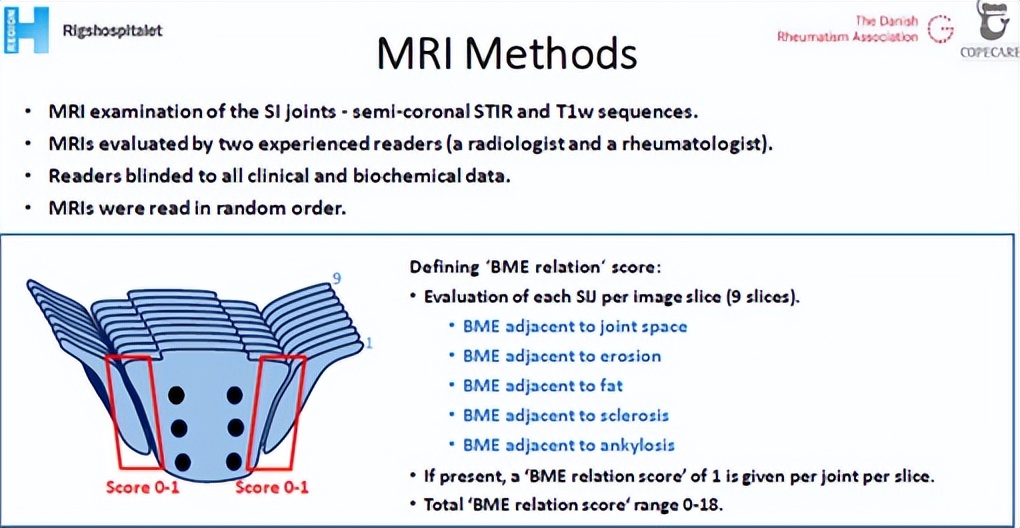 骶髂关节骨髓水肿最好的治疗方案,骶髂关节水肿是强直性脊柱炎吗