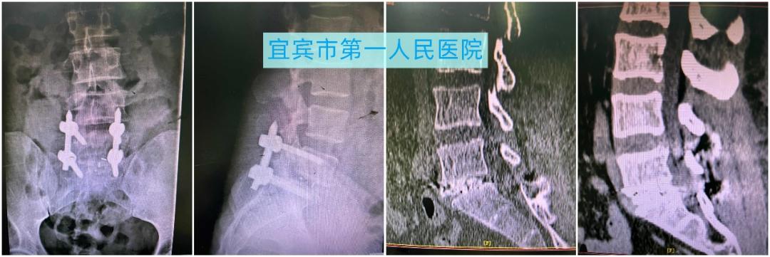 腰椎康复在家自我疗法,腰椎微创康复