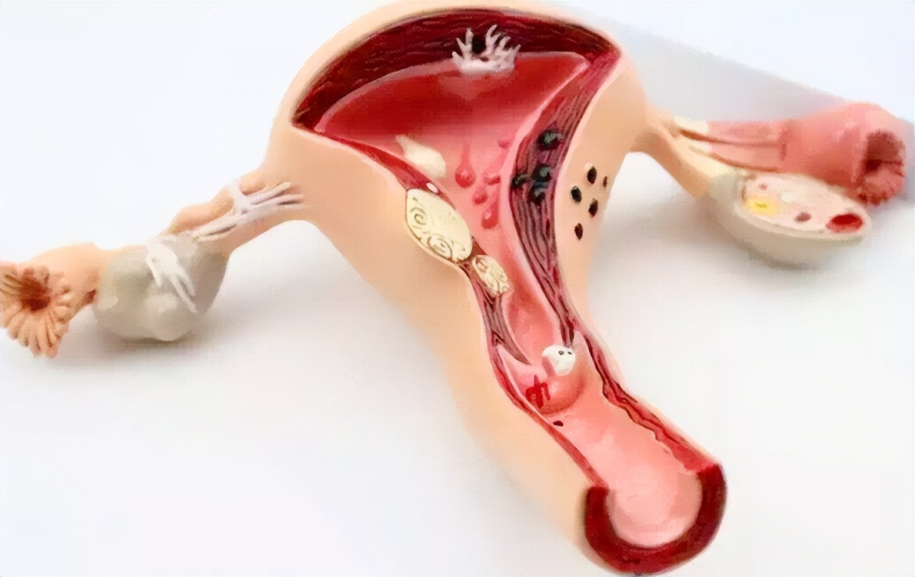 女人切除子宫和正常人区别,女人切掉子宫和正常人有什么区别