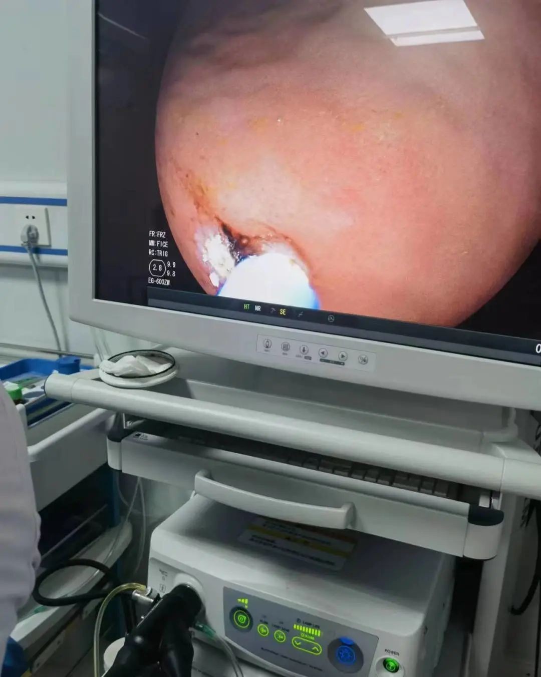 氩气刀治疗,氩气刀微创消融