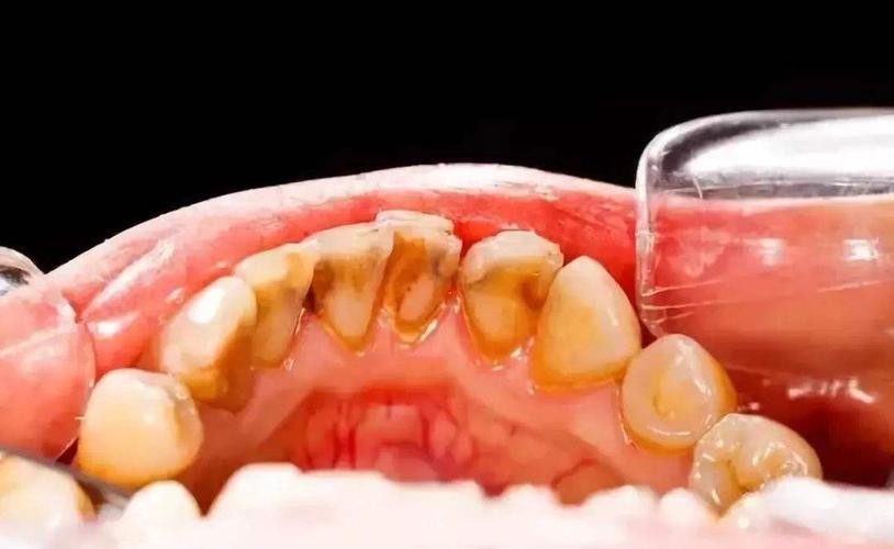 有一种痛叫口腔溃疡对症或能缓解,有一种痛叫做口腔溃疡如何缓解