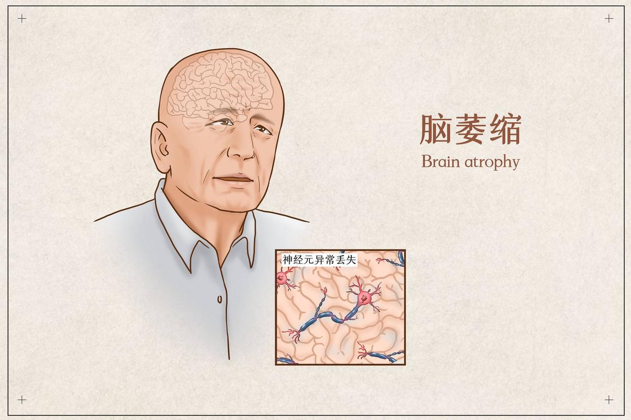 大脑萎缩6个反应,大脑开始萎缩有什么症状
