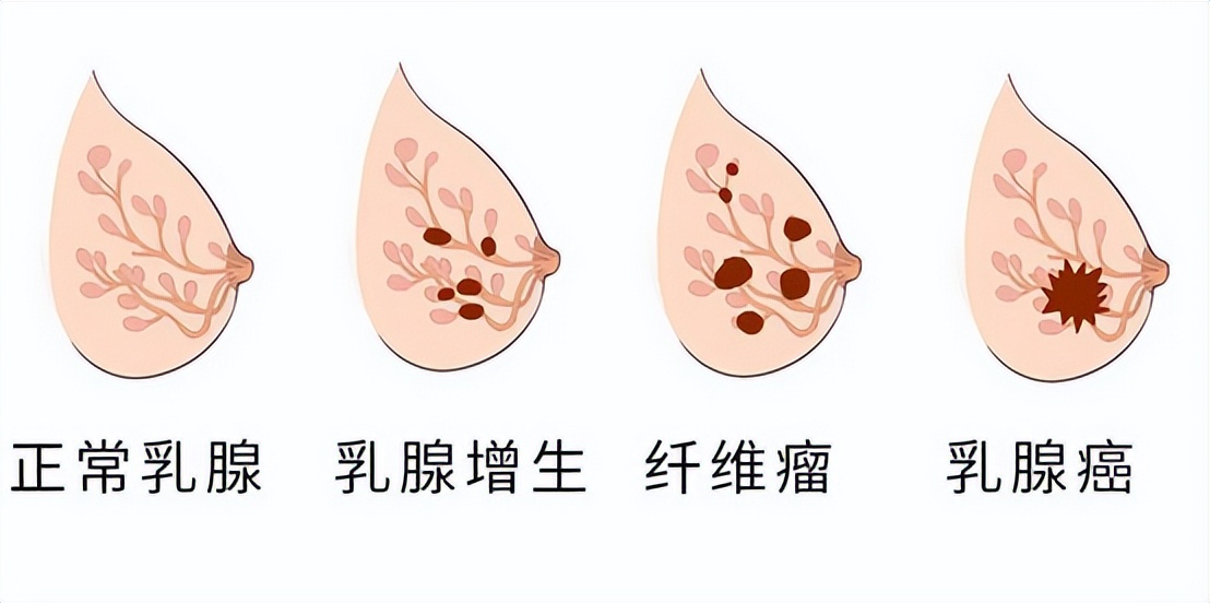 女生胸部上长了白色小点点,女生胸部长了好多小红点疙瘩