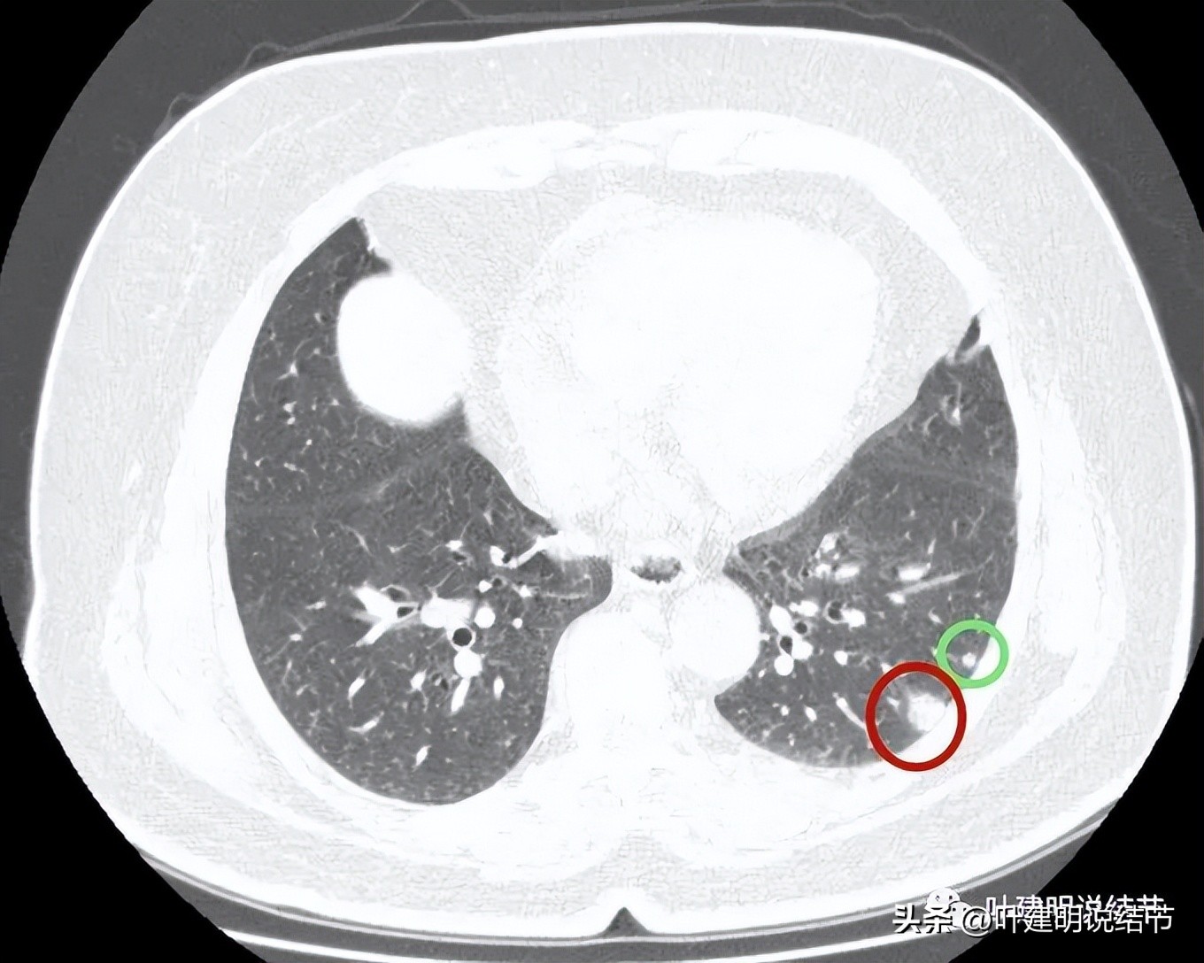 肺结节实性为什么建议抗炎治疗,肺上实性结节抗炎后变成空洞