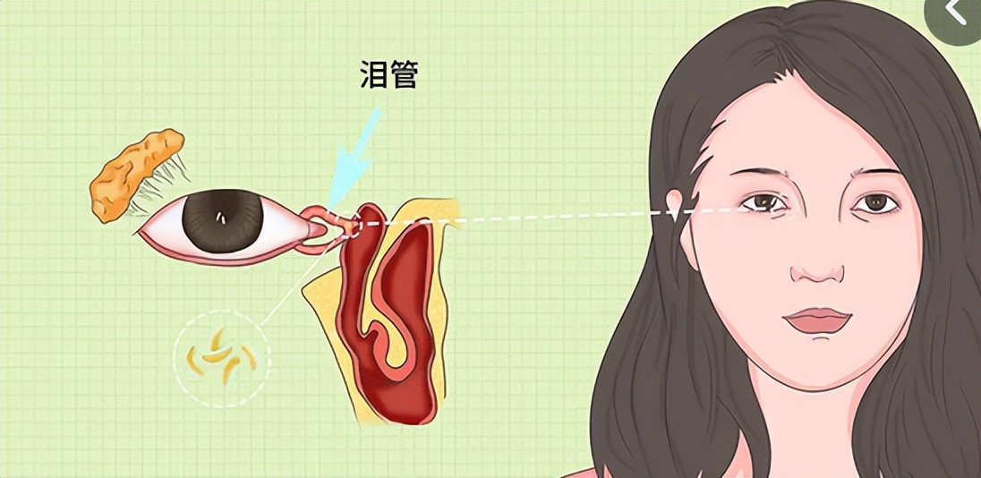 老年人泪道阻塞怎么按摩治疗视频,泪管堵塞中医手法治疗