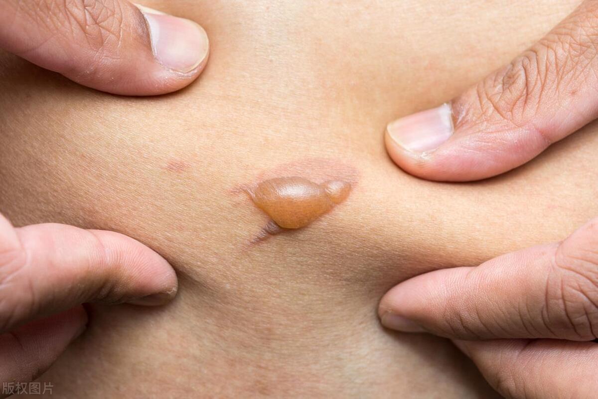 幼儿烫伤急救步骤及预防烫伤对策,烫伤病人的护理诊断及护理措施