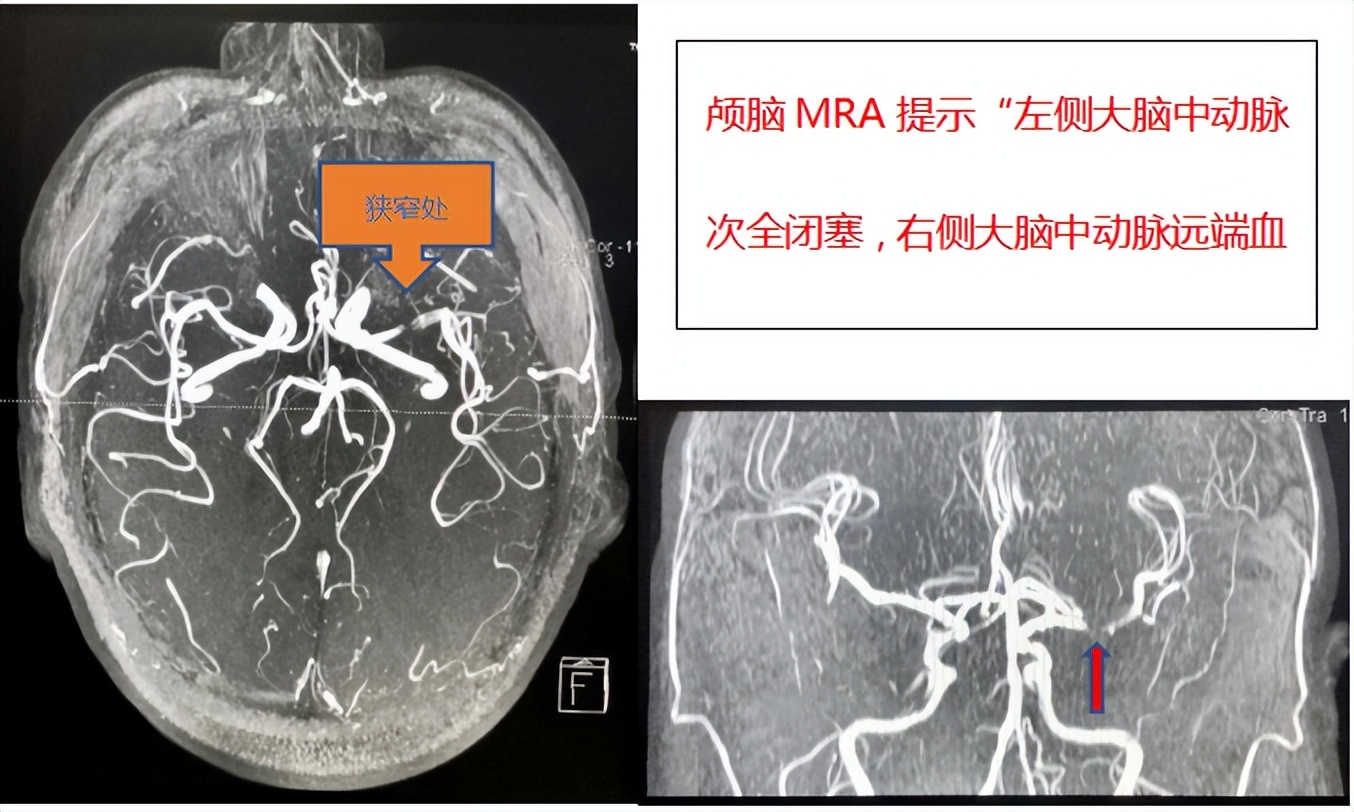 左侧大脑中动脉重度狭窄手术过程,颅内动脉重度狭窄能做手术吗