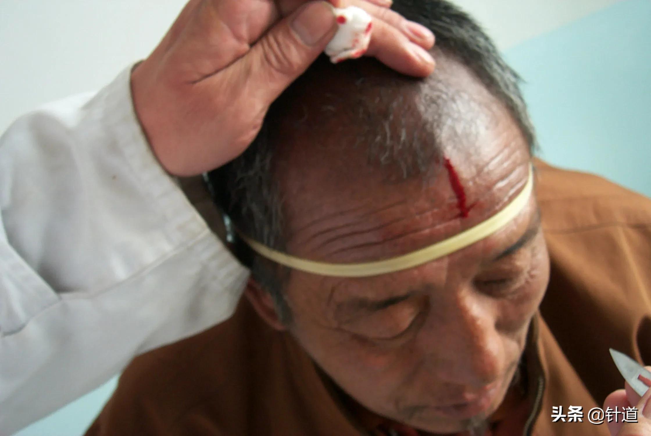 贺普仁的贺氏针灸三通法详解,针灸贺普仁