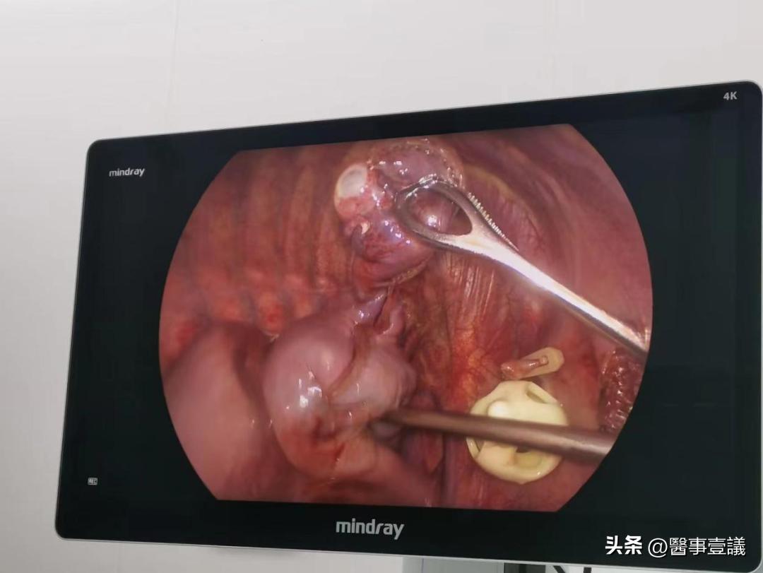 微创肺大泡切除,两肺多发肺大泡手术可以微创吗