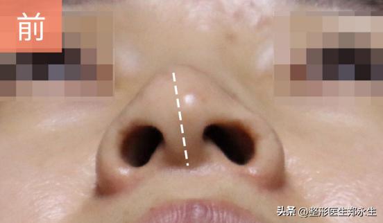 被老公打歪鼻骨留下后遗症,女的鼻子被打歪了