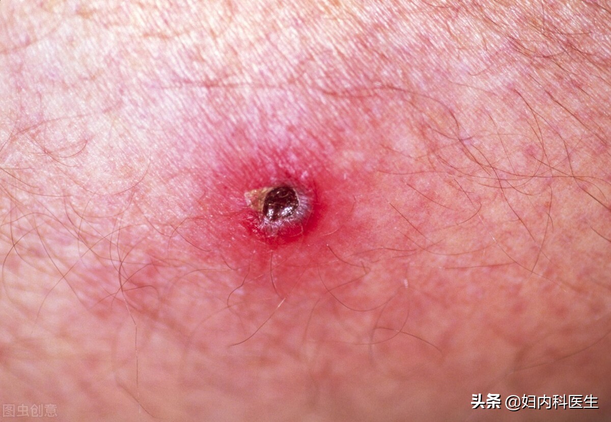 河南频繁有人因蜱虫病去世，蜱虫病到底是何病？为何致人于死地